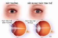 Các thuật ngữ liên quan tới mắt và ngành kính mắt