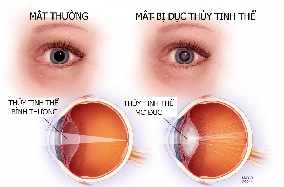 Các thuật ngữ liên quan tới mắt và ngành kính mắt
